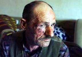 Beaten detainee in Kosovo